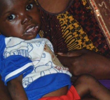 La malnutrition au Mali : une question de santé publique
