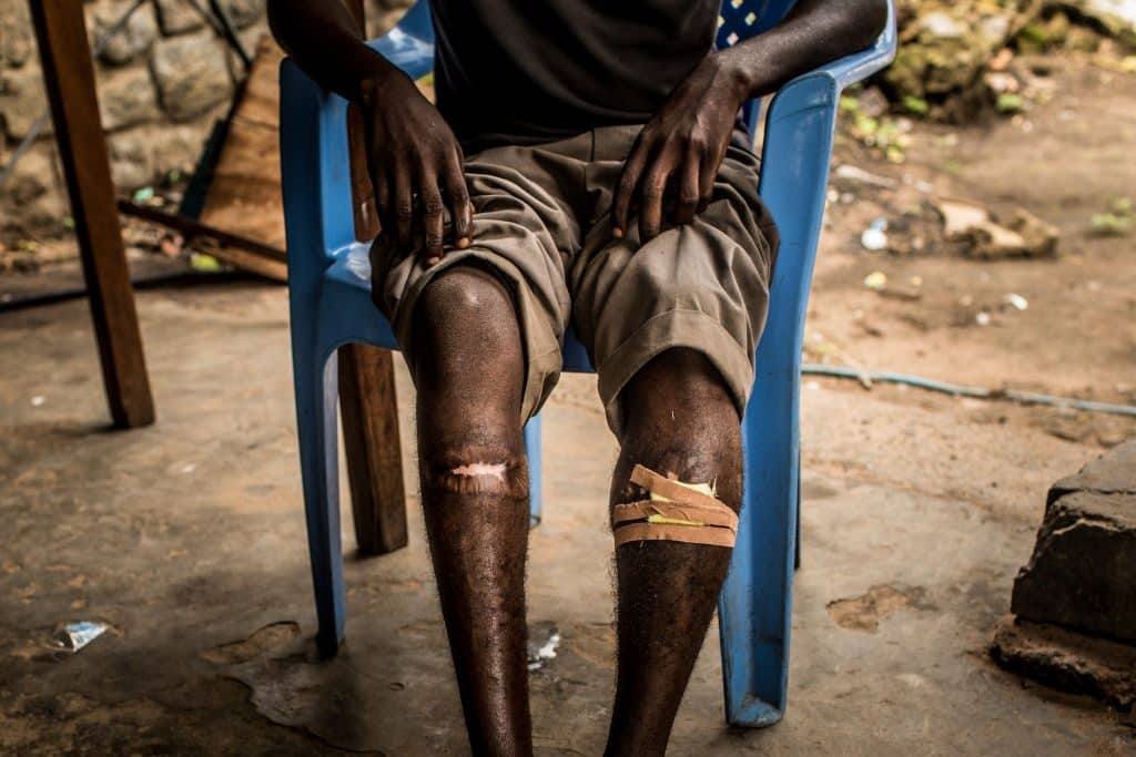 Le mercredi 31 janvier 2018, Albert, 16 ans, ancien enfant soldat, montre les blessures qu'il a subies aux jambes à cause de tirs. Désormais il est au Centre pour Transit et Orientation (CTO), un centre de réintégration parrainé par l'UNICEF pour les enfants associés à des groupes armés, à Kananga, dans la région du Kasaï, en République démocratique du Congo. © UNICEF/UN0162345/Tremeau