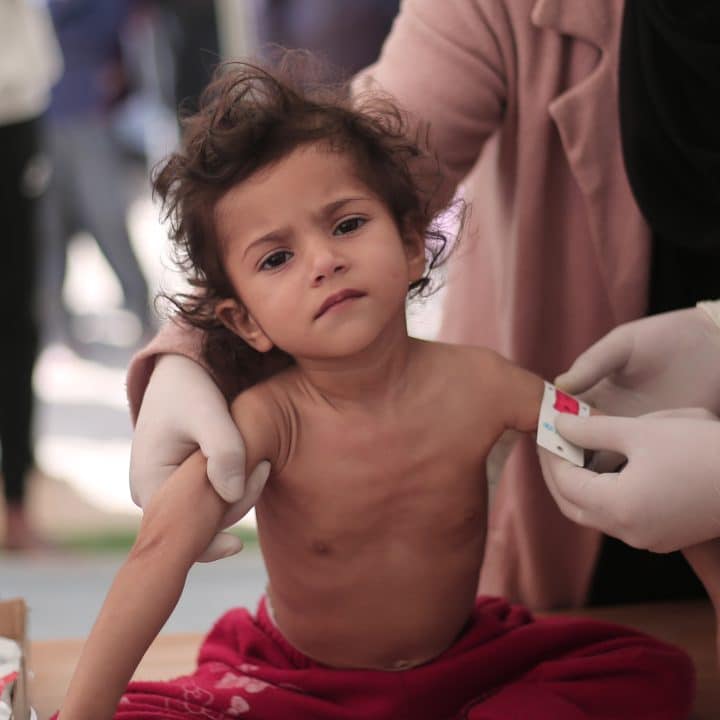 Leen, 2 ans, souffre de malnutrition aiguë sévère. Elle souffre d'une perte de poids et d'une atrophie musculaire drastiques. © UNICEF/UNI519944/
