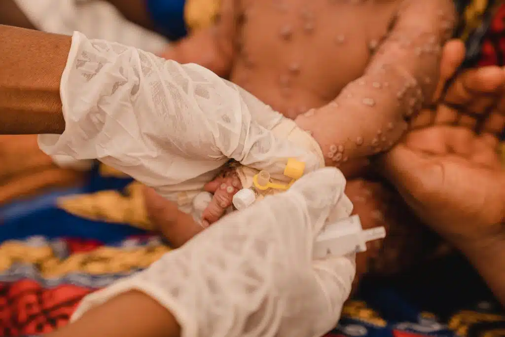 Le 24 juillet 2024, Aline*, 1 mois, est atteinte de Mpox. Elle est prise en charge à l'unité de soins pour la variole de l'hôpital Kamanyola, soutenu par l'UNICEF, dans la province du Sud-Kivu, en République démocratique du Congo. © UNICEF/UNI624789/Benekire