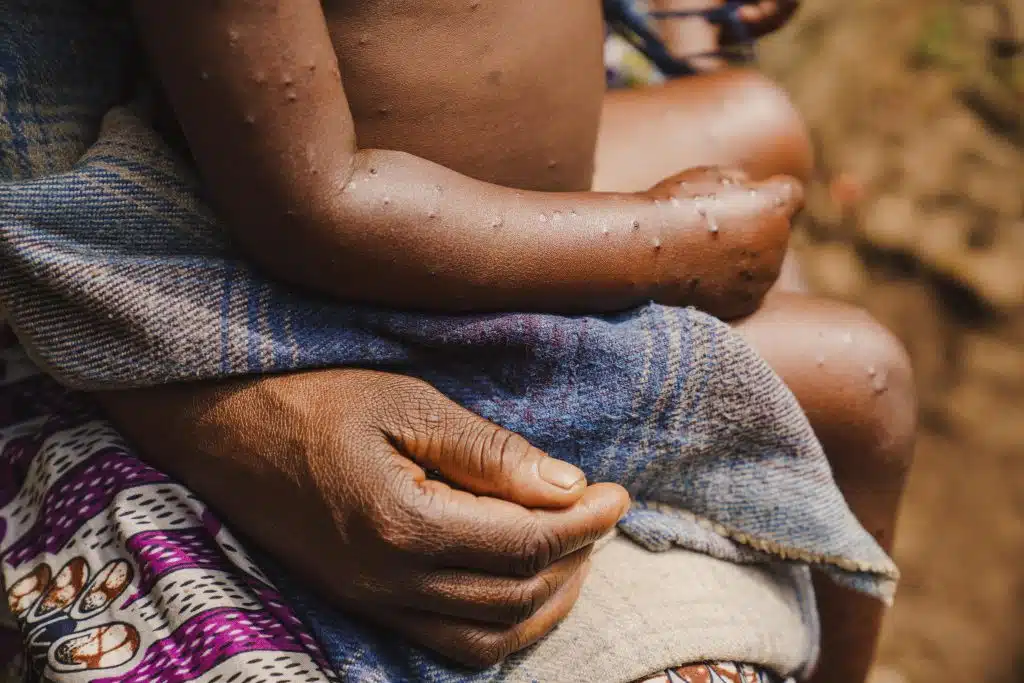L'hôpital de Kavumu a enregistré son premier cas de Mpox en juin 2024. Entre juin et juillet 2024, l'hôpital avait déjà enregistré 175 cas suspects de la maladie, dont 114 guérisons, 56 personnes en cours de traitement et 5 décès. Les patients sont principalement des enfants de moins de 5 ans.© UNICEF/UNI624811/Benekire