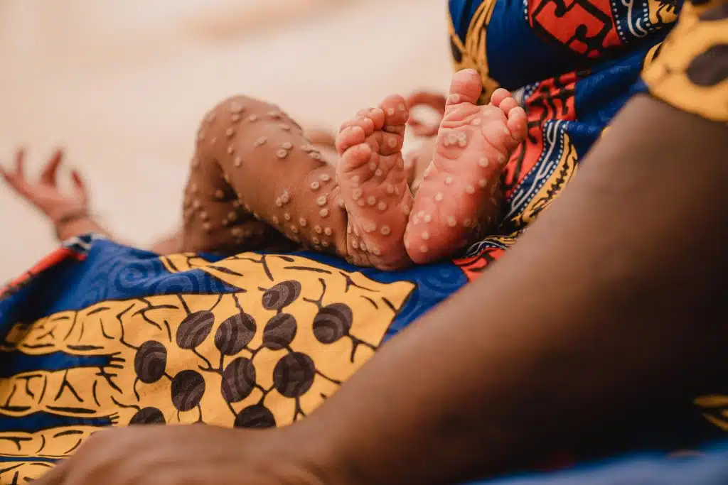 Le 24 juillet 2024, Aline*, 1 mois, est atteinte de Mpox. Elle est prise en charge à l'unité de soins pour la variole de l'hôpital Kamanyola, soutenu par l'UNICEF, dans la province du Sud-Kivu, en République démocratique du Congo. © UNICEF/UNI624815/Benekire