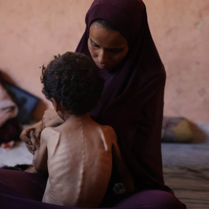 A Gaza, Yazan, âgé de deux ans et souffre de malnutrition sévère. Sa mère, Naima, déclare : « Nous n'avons pas reçu de farine ni aucune aide alimentaire depuis deux mois. » © UNICEF/UNI838255/El Baba